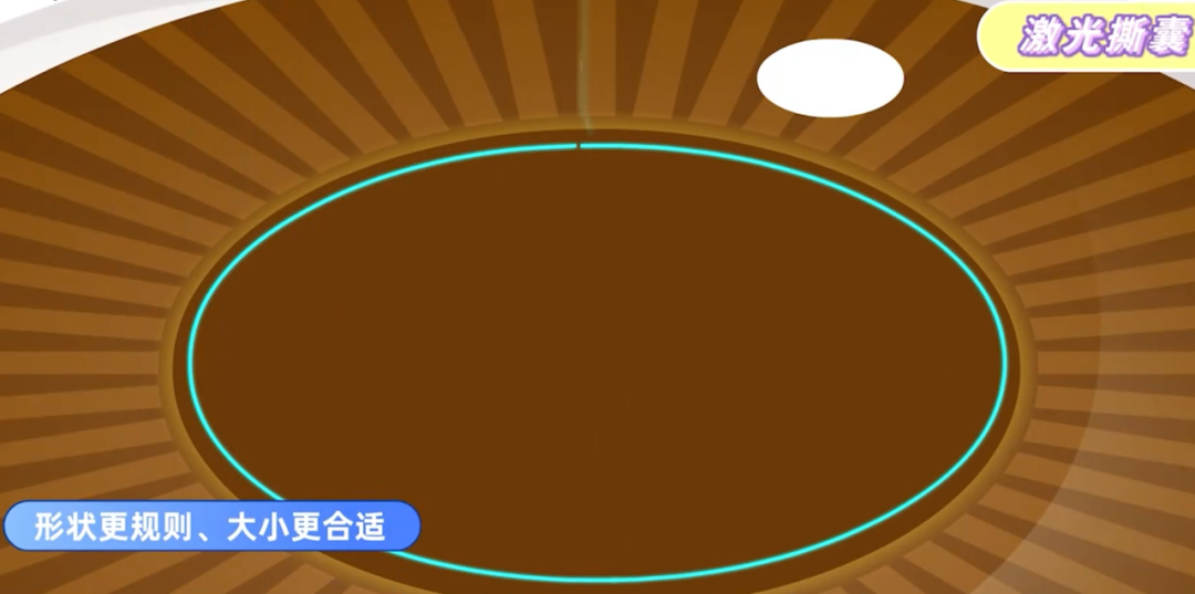 飞秒激光辅助白内障手术,究竟是「智商税」还是「黑科技」?