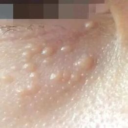 为眼霜申冤！眼周这些小颗粒，到底是什么啊啊啊啊？