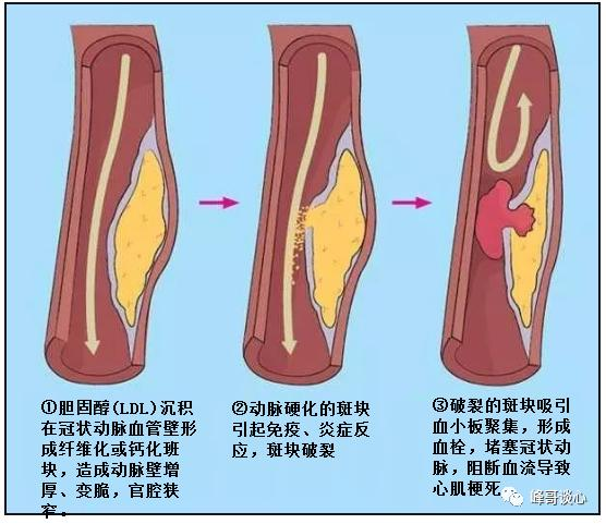 【协作组科普】不止肺癌!吸烟对心脏的伤害,远比想象的可怕