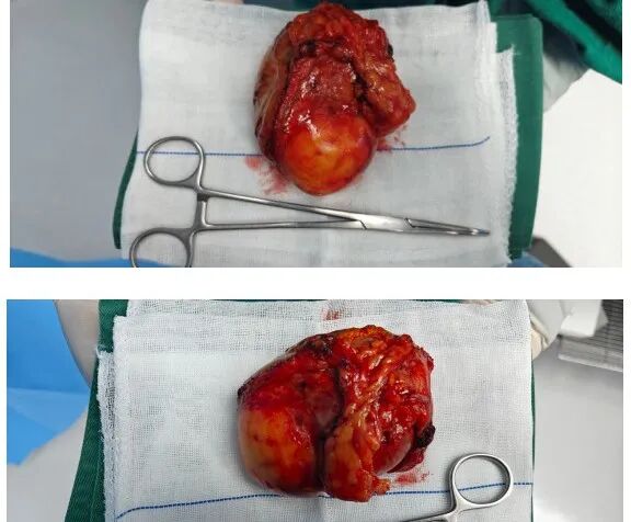 8.2 cm 巨大肾上腺髓脂瘤!国文泌尿外科机器人手术破解高龄多病患者治病难题