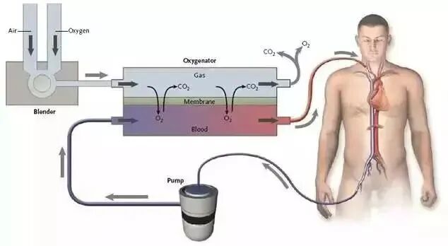 急救能力再进阶!和祐急诊科完成首例床旁 ECMO 救治