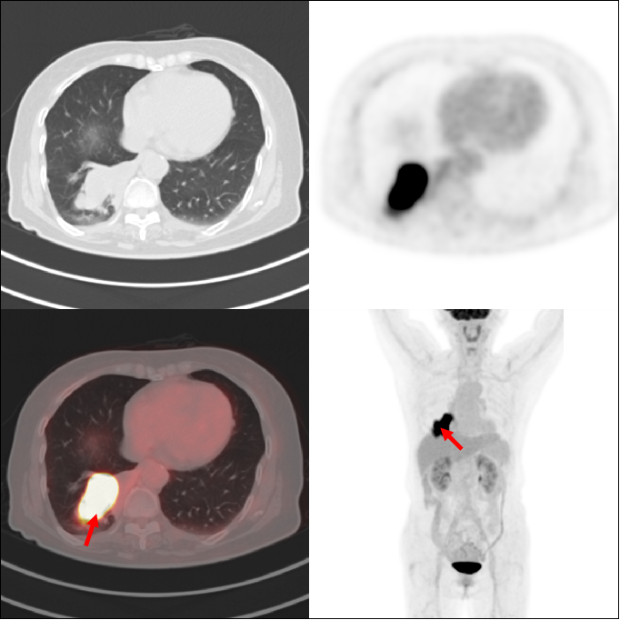 PET/CT 报告中的高代谢一定是异常吗?一文读懂