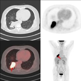 PET/CT 报告中的高代谢一定是异常吗？一文读懂