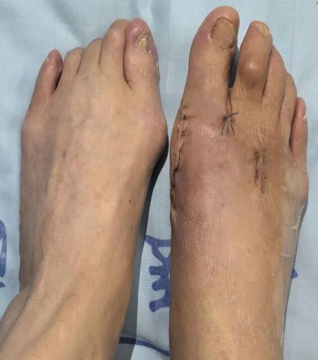 大脚骨、穿鞋痛?莫让足拇外翻拖垮你的脚!一文读懂矫正全方案