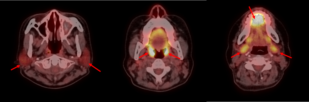 PET/CT 报告中的高代谢一定是异常吗?一文读懂
