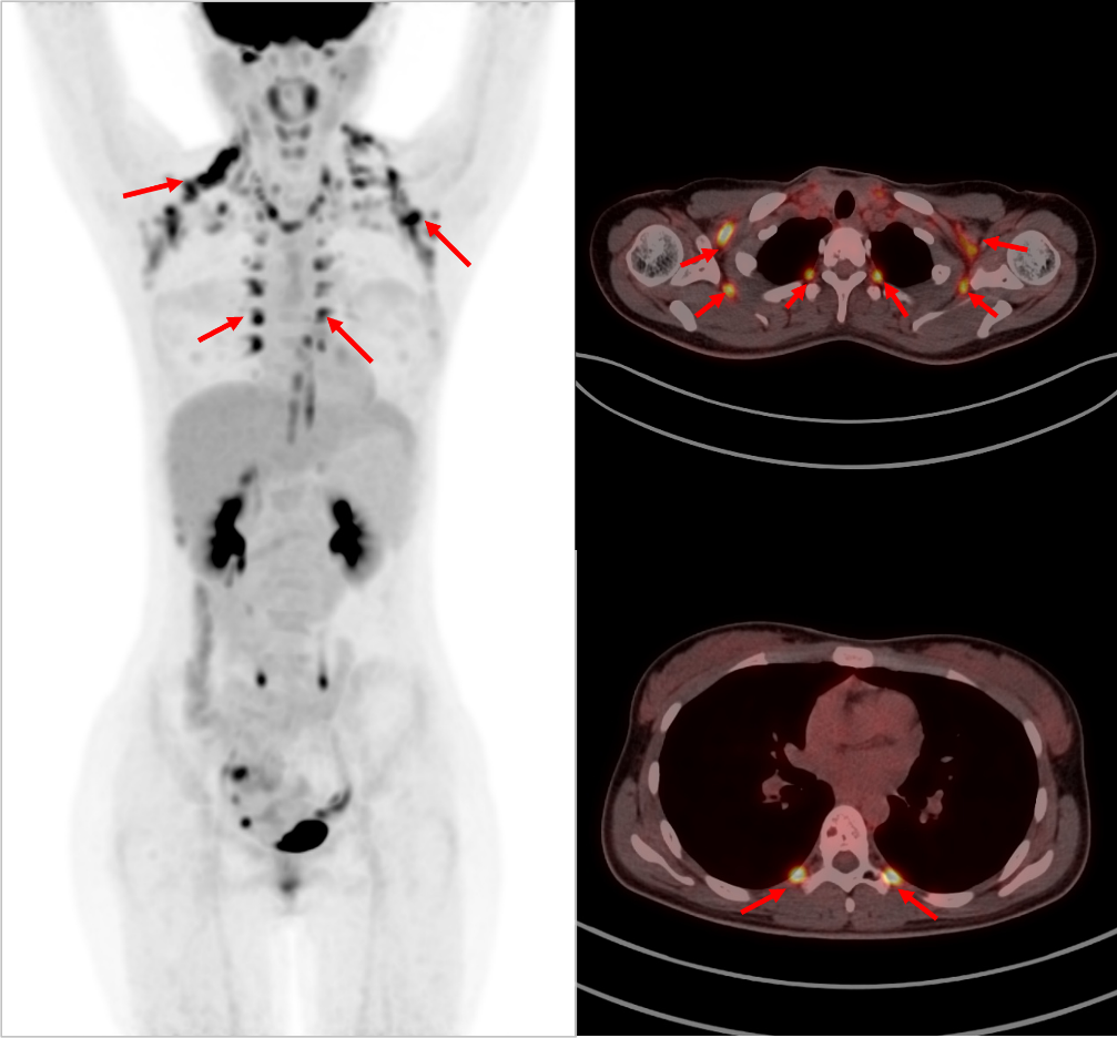 PET/CT 报告中的高代谢一定是异常吗?一文读懂