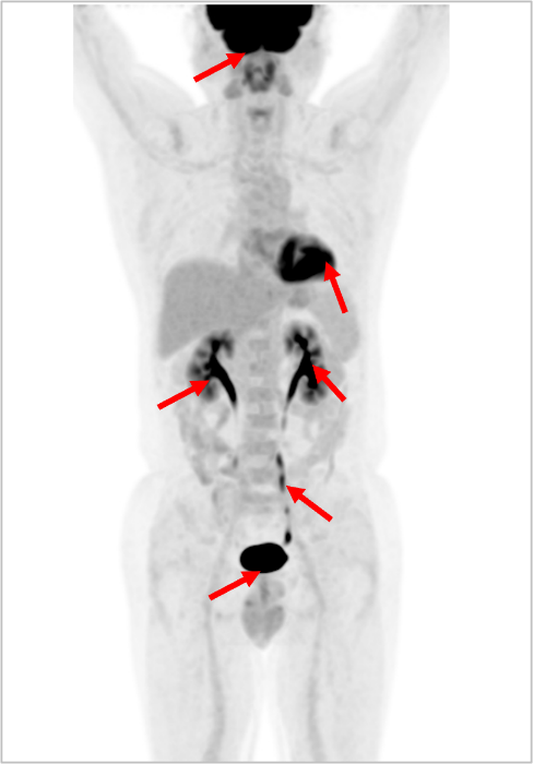 PET/CT 报告中的高代谢一定是异常吗?一文读懂