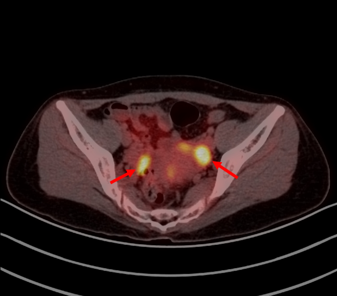 PET/CT 报告中的高代谢一定是异常吗?一文读懂