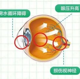 3 分钟了解青光眼：早检早治很重要