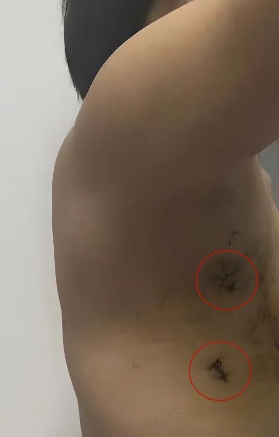 做心脏手术,还能不开胸?!这群医生,常规开展「美容」心脏术式~