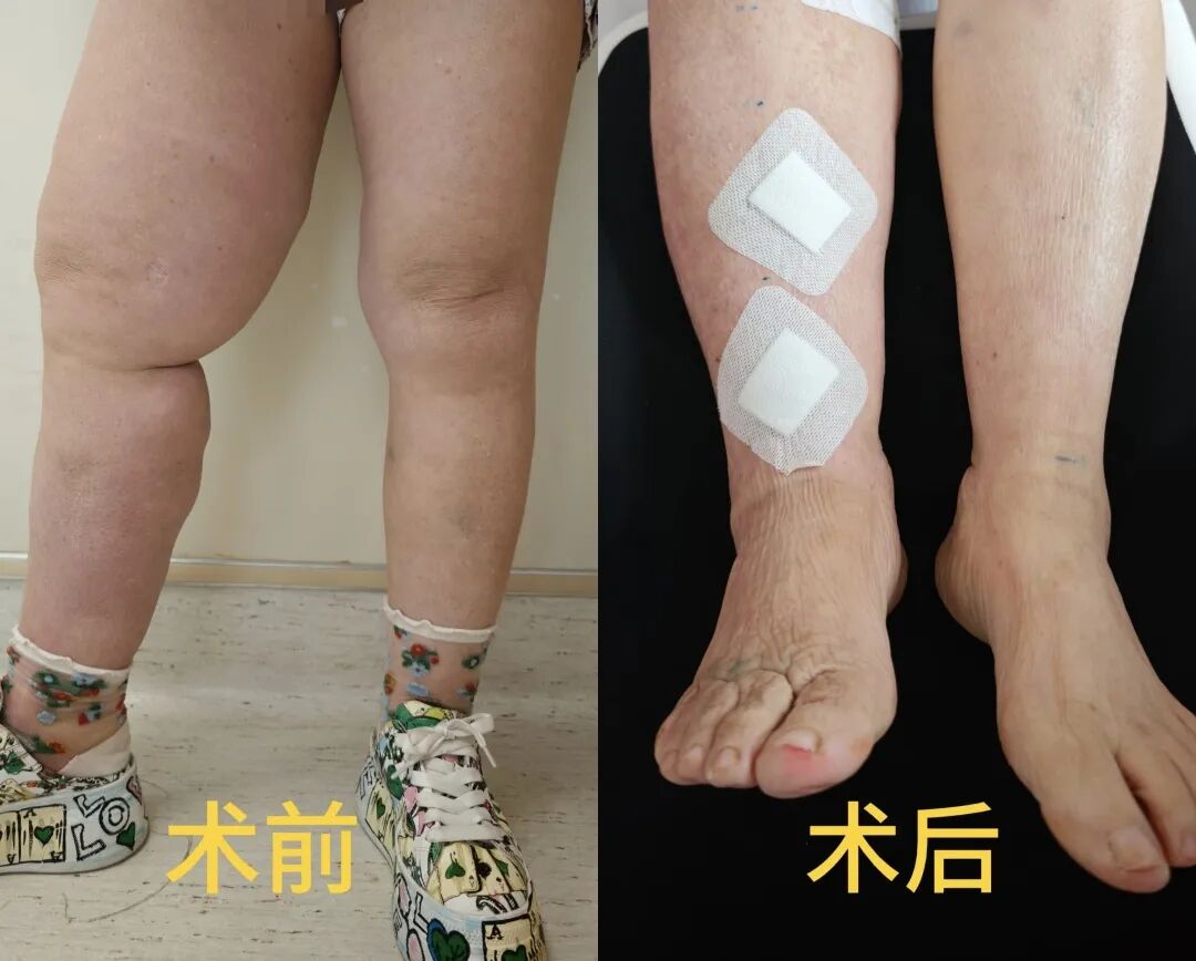 腿围立减 10 厘米!东阳女子 5 年「大象腿」一朝消失,这项超显微技术太牛了!