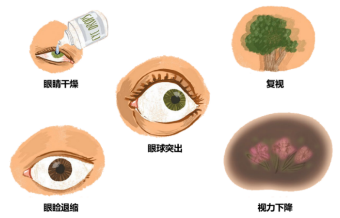 医路科普 | 眼睛变凸别忽视!一文读懂甲亢突眼
