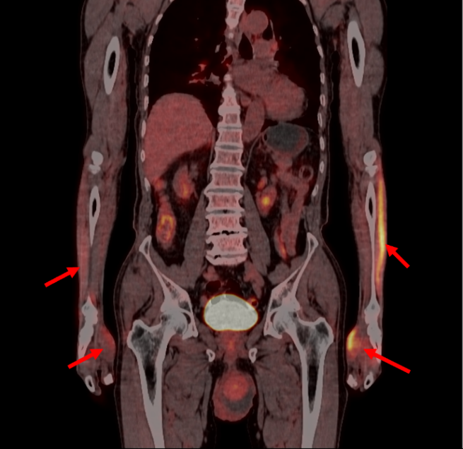 PET/CT 报告中的高代谢一定是异常吗?一文读懂