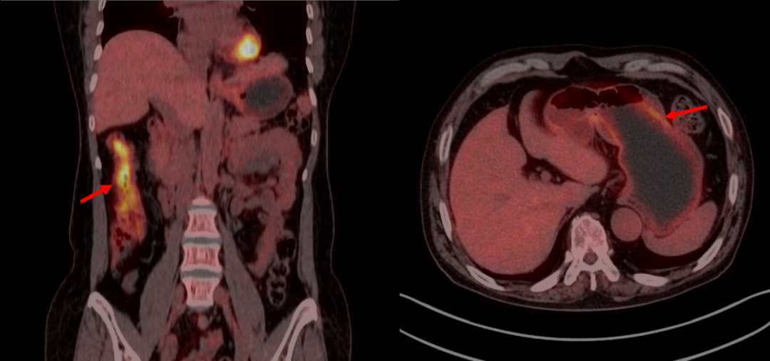 PET/CT 报告中的高代谢一定是异常吗?一文读懂