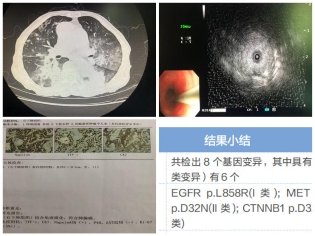【医路有术】抽丝剥茧，识破 「肺炎伪装」 的肺腺癌