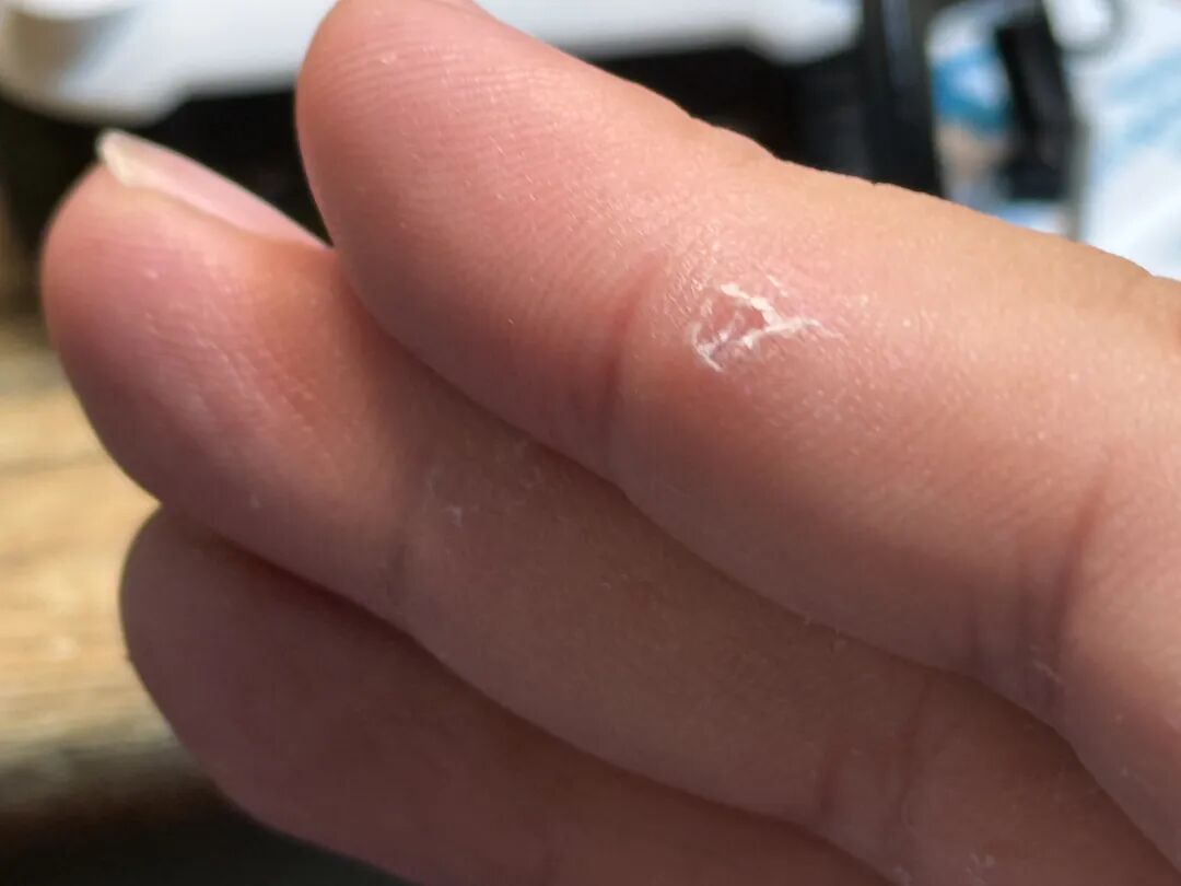 夏天手上长小水泡痒到抓心?别乱挠!这不是脚气,是汗疱疹
