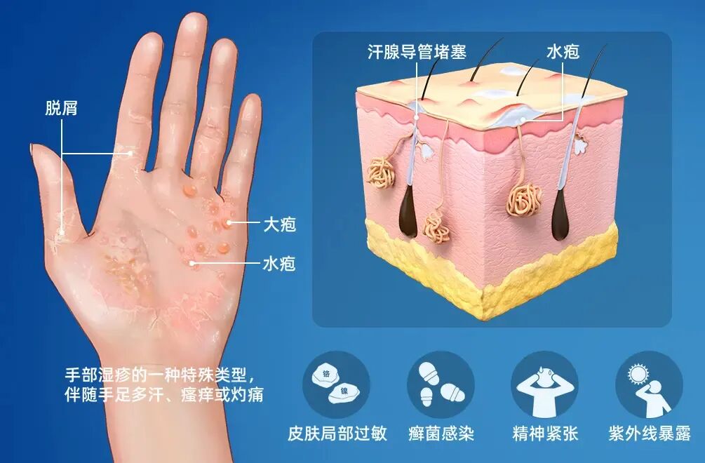 夏天手上长小水泡痒到抓心?别乱挠!这不是脚气,是汗疱疹