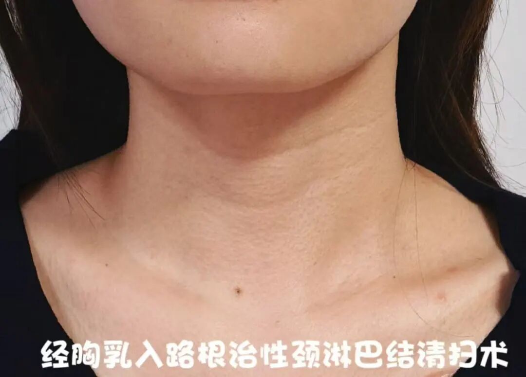【守护健康】我院成功开展经胸乳入路甲状腺癌复发伴颈淋巴结转移根治清扫术