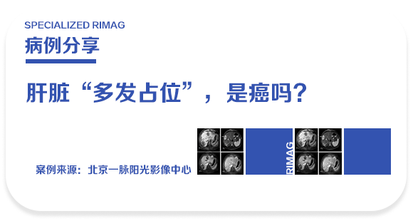 典型病例 | 26 岁姑娘体检发现肝脏「多发占位」,是癌吗?