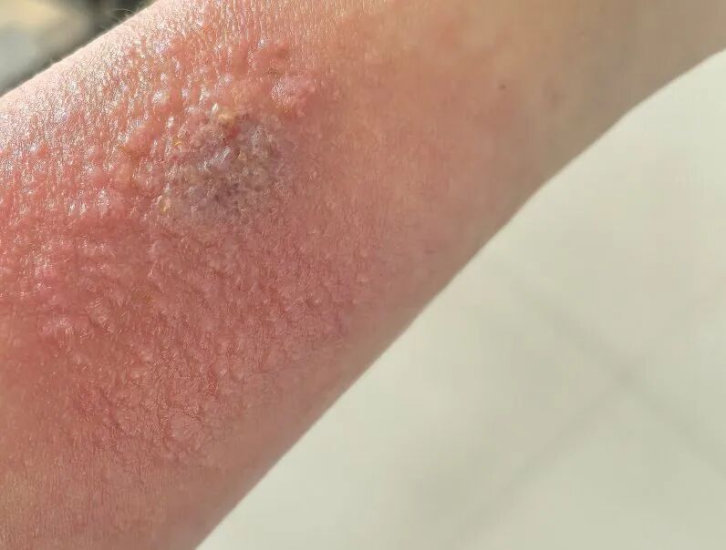 隐翅虫又来了!有人脸上破溃,有人皮肤化脓