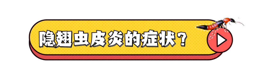 隐翅虫又来了!有人脸上破溃,有人皮肤化脓