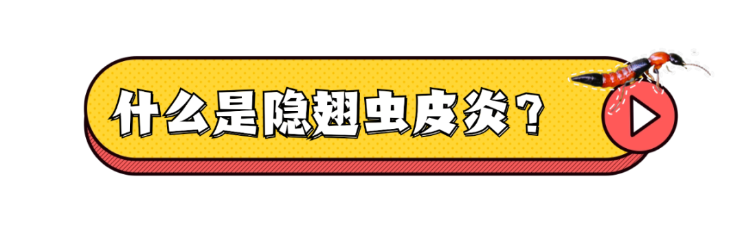 隐翅虫又来了!有人脸上破溃,有人皮肤化脓