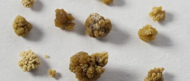 男子肚子绞痛，医生一眼看穿！医生提醒：近期高发这种病