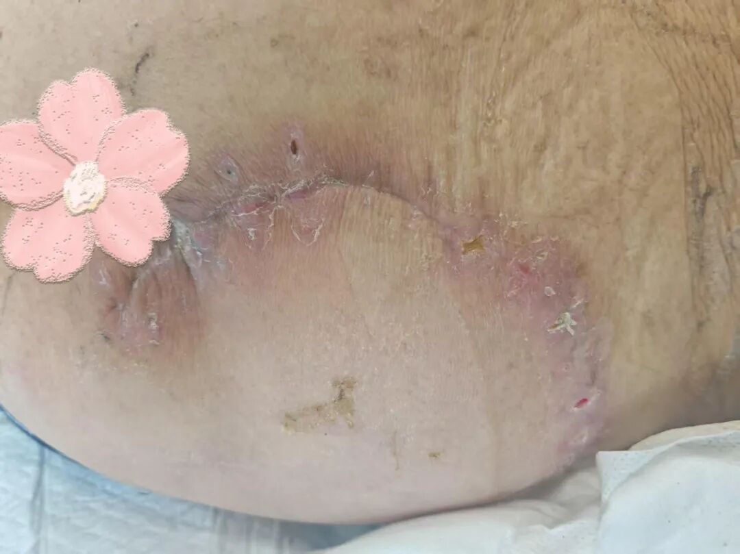 以术为刃 以爱为盾——Ⅳ期压疮老人的重生:皮瓣移植术的守护