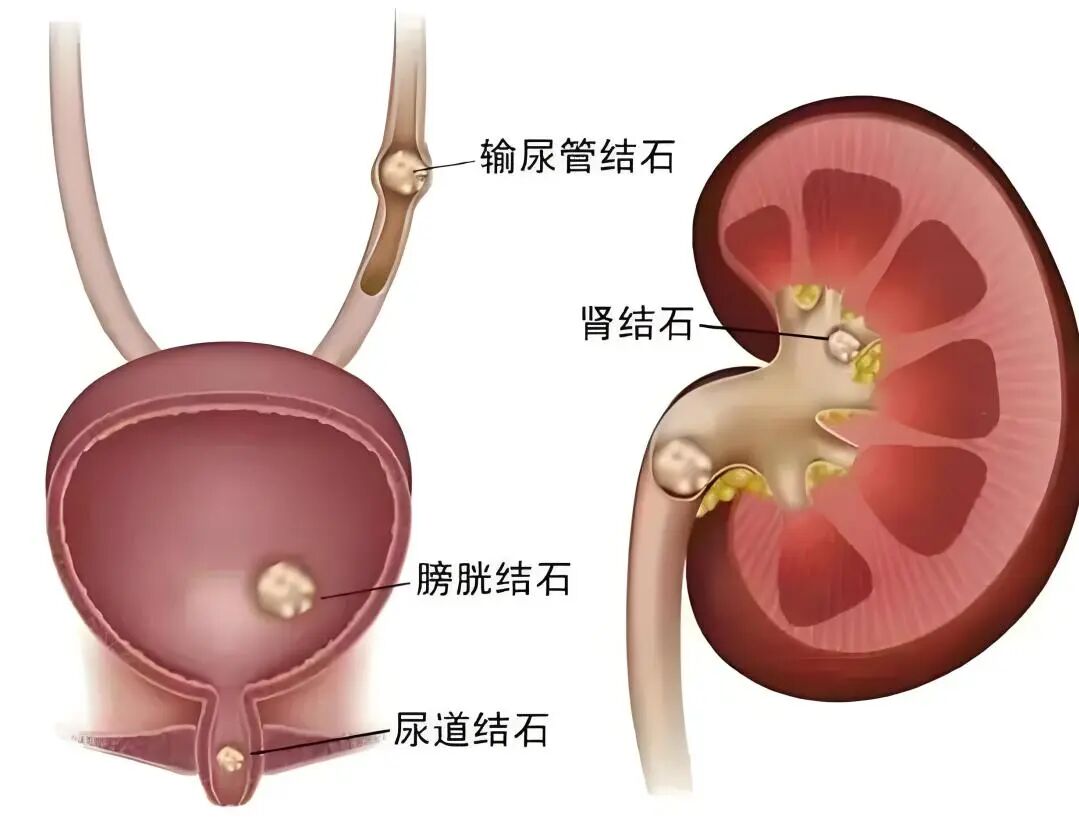男子肚子绞痛,医生一眼看穿!医生提醒:近期高发这种病