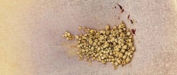 尿频尿急还尿痛？国文医院泌尿外科一次手术解决前列腺增生+膀胱结石双重困扰