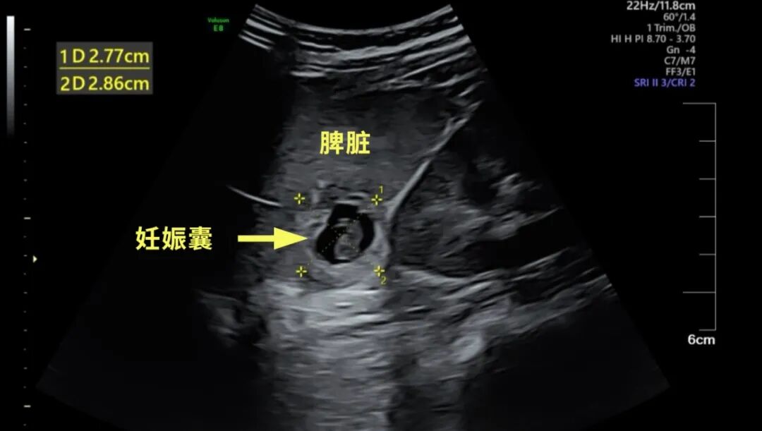 罕见!胚胎长在脾脏里