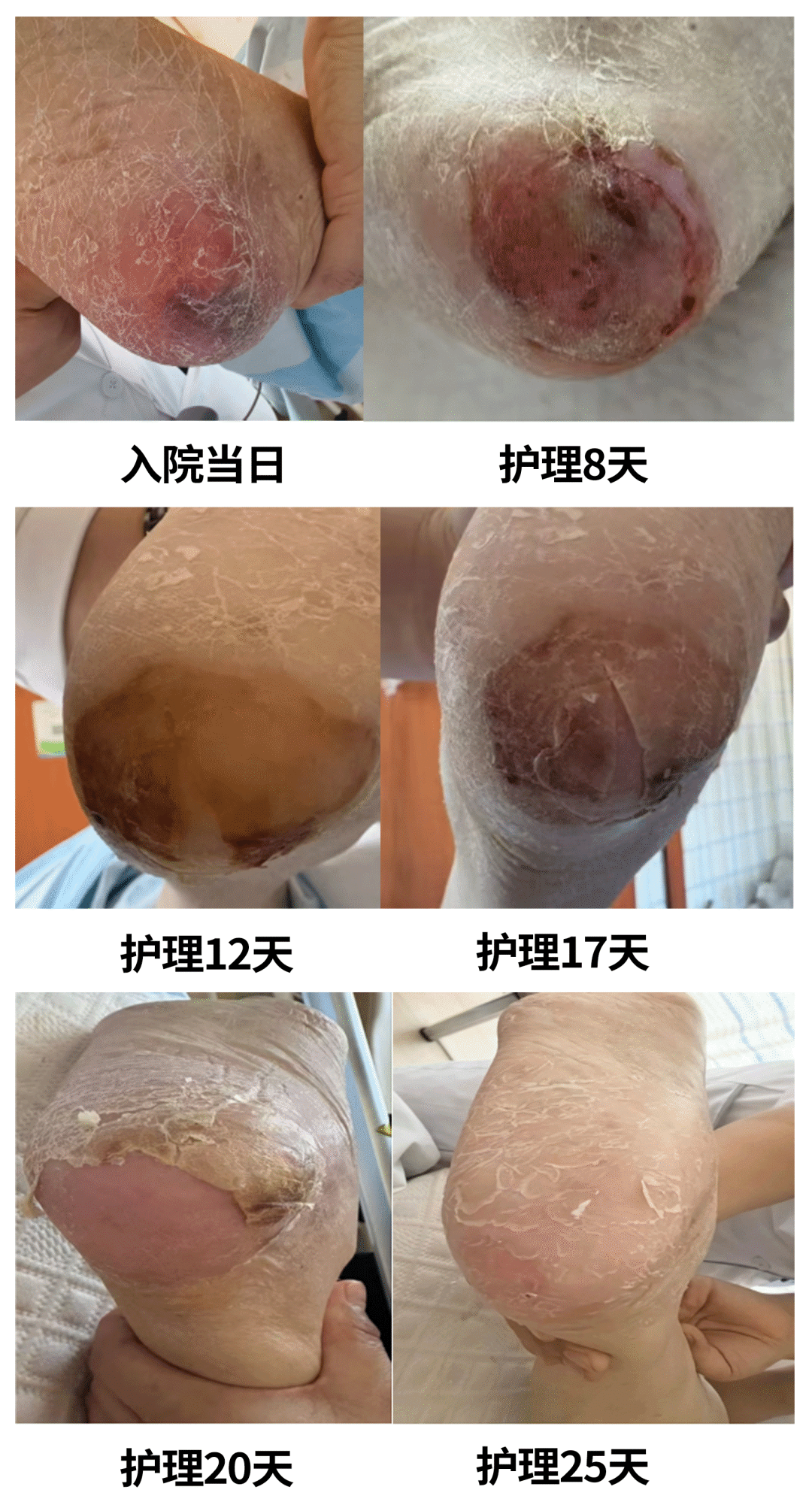 【一洲护理】精细护理暖人心,专业守护促康复