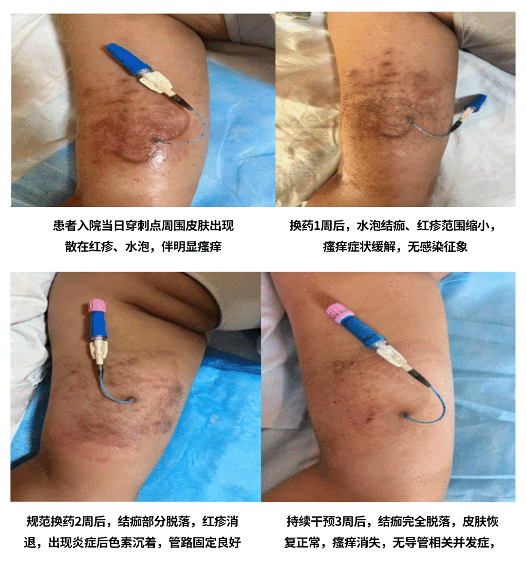 【一洲护理】精细护理暖人心,专业守护促康复