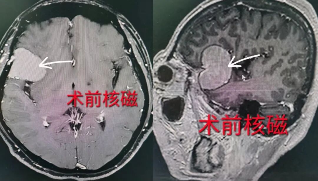 【医疗技术】我院神经外科完成高难度颅底手术,ERAS 助推患者快速康复
