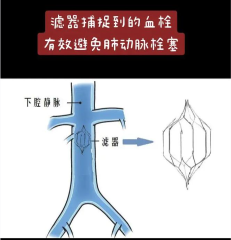跨越千里生命接力 北京积水潭医院郑州医院多学科协作处置滤器移位高危血管病例