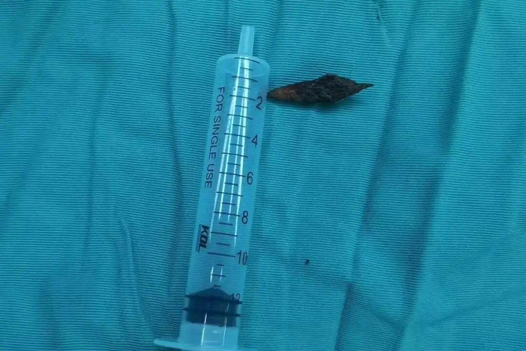 惊险!喝滋补汤吞下 1 颗枣核,大爷肛周剧痛坐立难安!医生从这里取出 「元凶」…