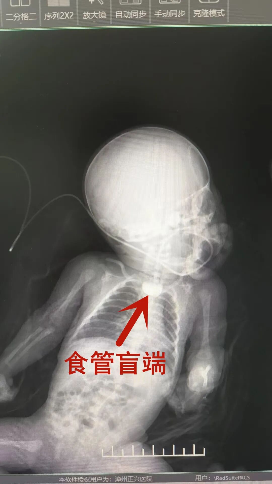 出生仅 56 天！正兴 MDT 巧借「他山之石」拿下全国首例