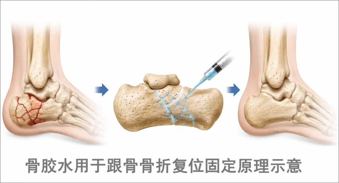 强基冲高新启航 | 仁慈创伤智慧骨科硬核突破！世界首创术式刷新运动康复纪录