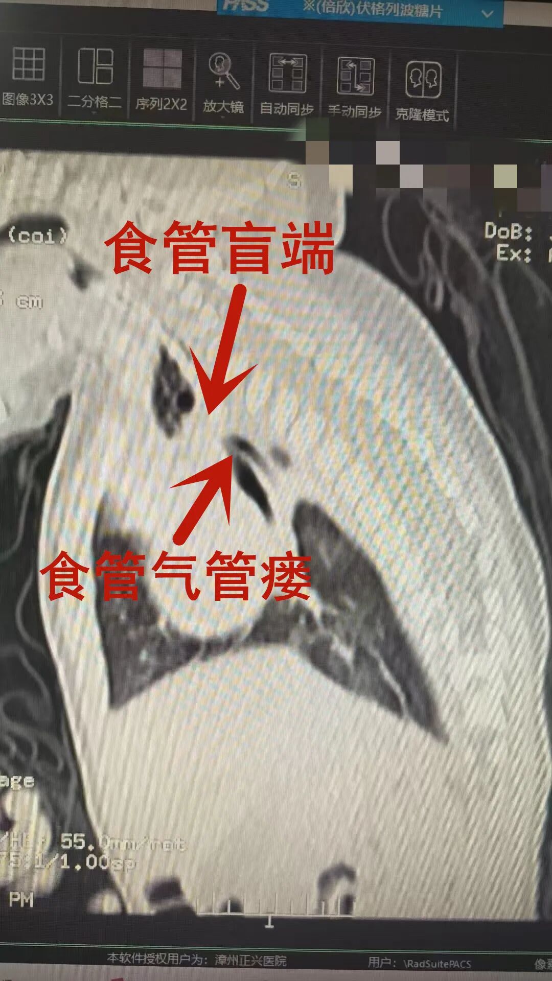 出生仅 56 天！正兴 MDT 巧借「他山之石」拿下全国首例