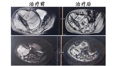 由表及里，系统决策｜河北一洲肿瘤医院路泽军教授在 CSTRO 儿童肿瘤学组学术沙龙上分享质子治疗前沿思考