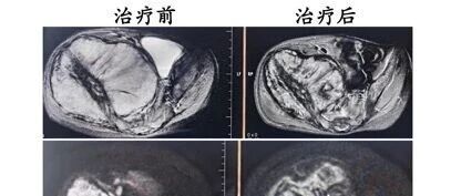 由表及里，系统决策｜河北一洲肿瘤医院路泽军教授在 CSTRO 儿童肿瘤学组学术沙龙上分享质子治疗前沿思考