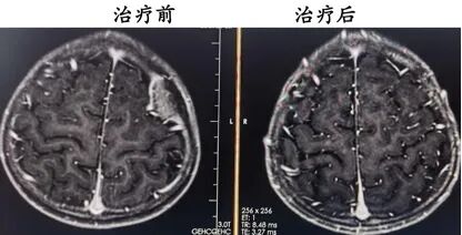 由表及里，系统决策｜河北一洲肿瘤医院路泽军教授在 CSTRO 儿童肿瘤学组学术沙龙上分享质子治疗前沿思考