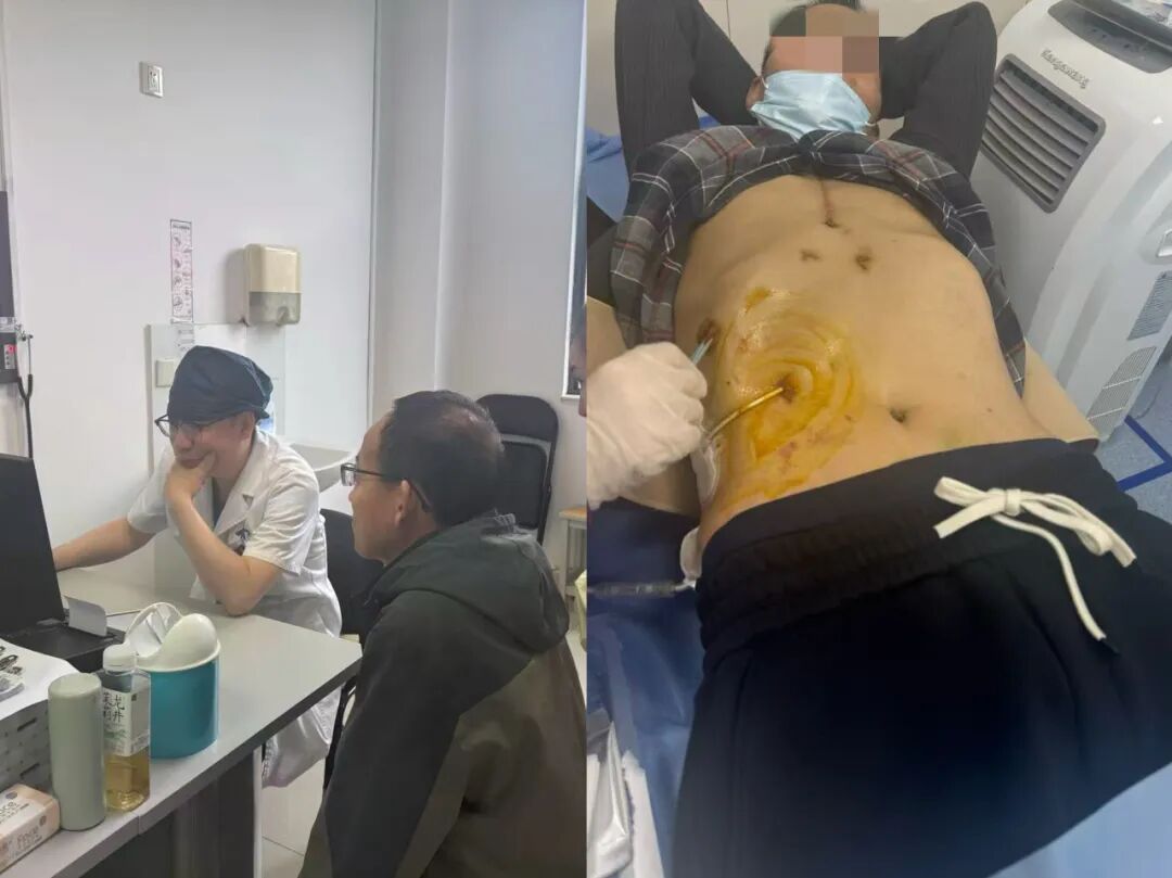 一颗人工心,关怀伴余生!交大一附院持续守护人工心患者每一次心跳