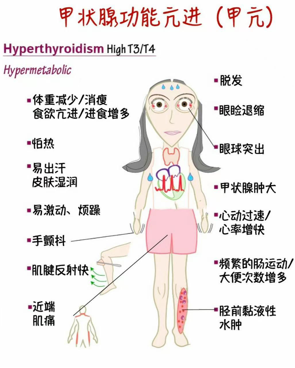 【人医科普】内分泌甲乳讲堂——新陈代谢飞速飙升?警惕甲亢找上门!