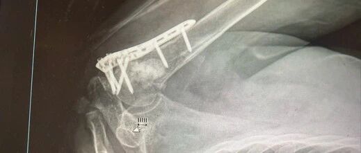 高龄老人不慎摔倒险致残！南京江北医院 2 小时极速手术护航晚年安康
