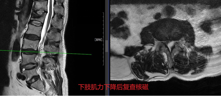 【医疗技术】微创除病灶，精准解病痛——我院脊柱外科成功开展内镜下腰椎感染椎管内脓肿清除术