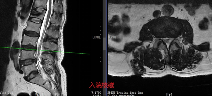 【医疗技术】微创除病灶，精准解病痛——我院脊柱外科成功开展内镜下腰椎感染椎管内脓肿清除术
