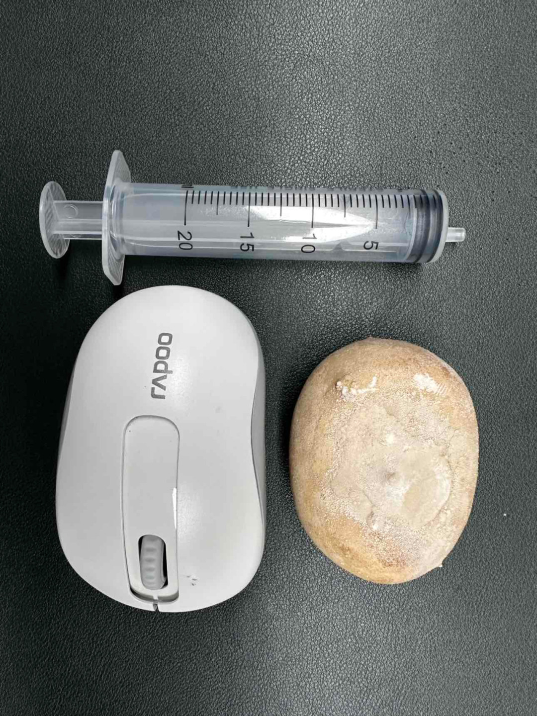 91 岁老人体内藏 7 cm 巨大膀胱结石,泌尿外科精细手术助老人摆脱排尿折磨