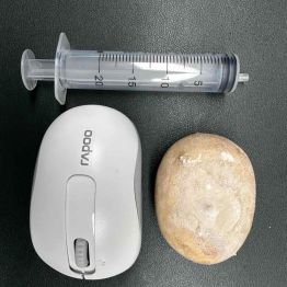 91 岁老人体内藏 7 cm 巨大膀胱结石，泌尿外科精细手术助老人摆脱排尿折磨