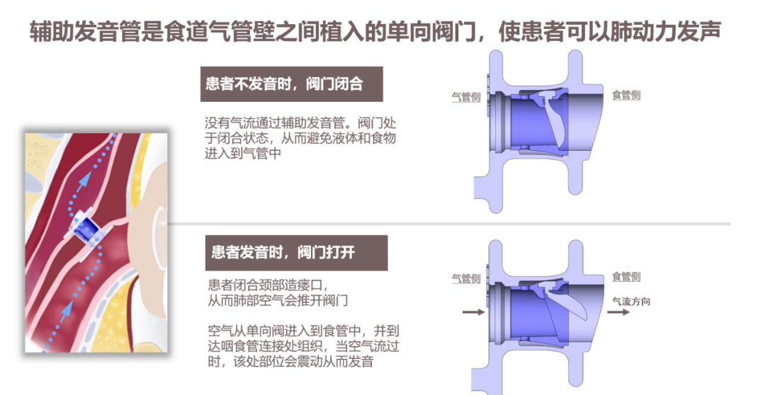 喜讯：广西医科大一附院牵头发布《喉全切除术后辅助发音管植入护理规范》团体标准